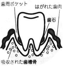 歯周病の進行状態