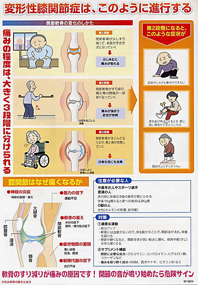 ひざに水がたまるとき 膝の痛み 痛みの症状